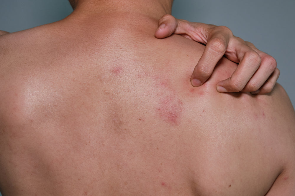 Body Acne Tips