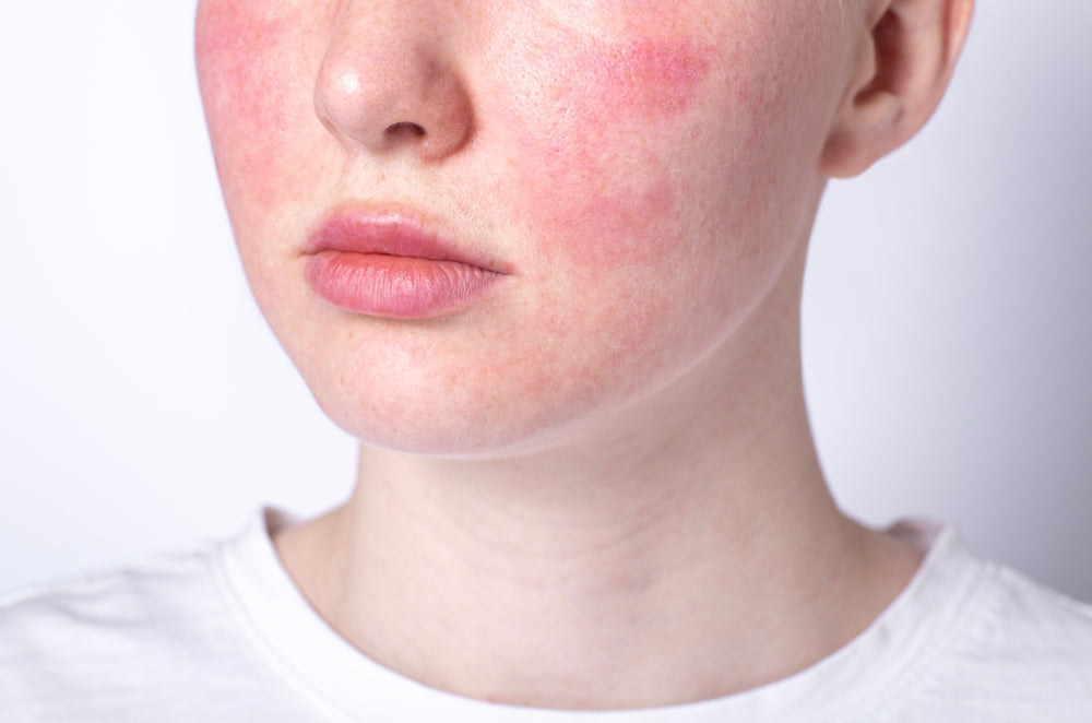 Understanding Skin Redness and Rosacea