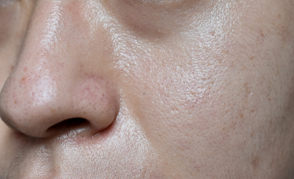 How do I deal with Oily skin as a teenager?