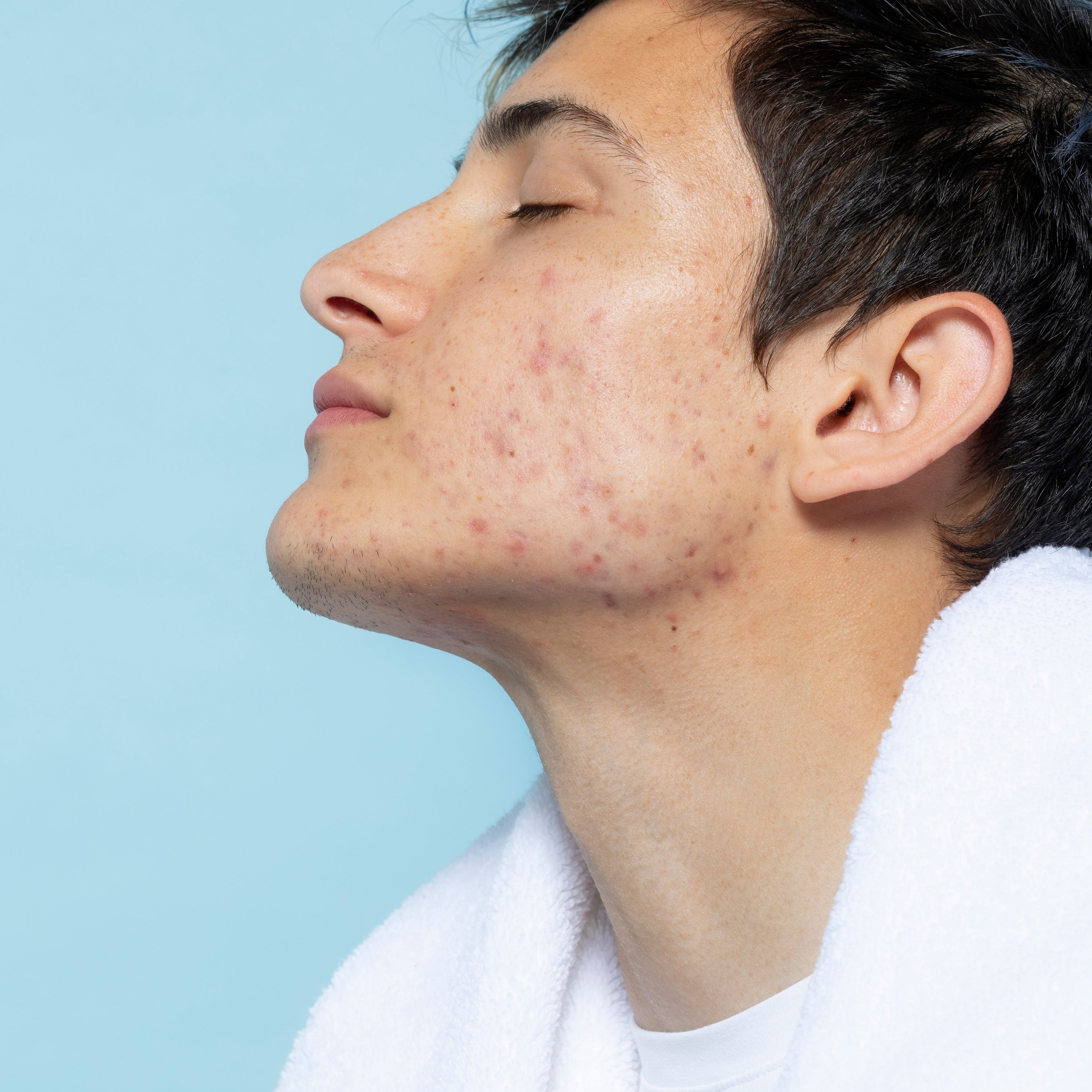 Debunking Acne "Cures" and TikTok Beauty Hacks